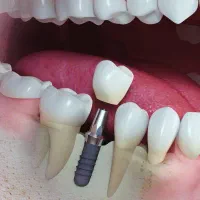 ایمپلنت کره یکروزه دیجیتال 15900 با روکش