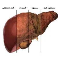 راه های درمان برای کبدچرب