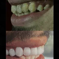 کامپوزیت و لمینت دندان|خدمات آرایشگری و زیبایی|ساری, |دیوار