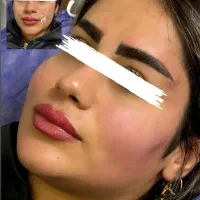 جشنواره تخفیفی ژل بوتاکس لیزر