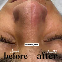 فیشیال تخصصی آقایان « پاکسازی پوست » فشیال فیشال|خدمات آرایشگری و زیبایی|مشهد, الهیه|دیوار