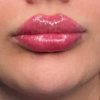 تزریق ژل لب روسی با متد تخصصی روسی و بوتاکس