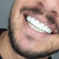 کامپوزیت دندان جشنواره|خدمات آرایشگری و زیبایی|یاسوج, |دیوار