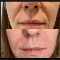 تزریق ژل و بوتاکس و اموزش