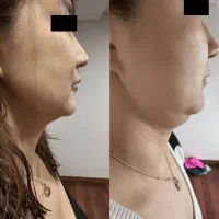 پی بی سرم کانتورینگ