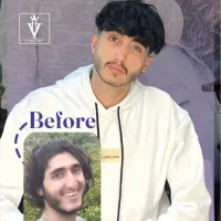 عمل بینی فقط ماهانه ۱۰تومن