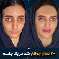 جشنواره کانتورینگ Pro Face بدون جراحی و بیهوشی|خدمات آرایشگری و زیبایی|مشهد, هفت تیر (حافظ)|دیوار