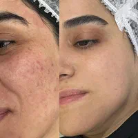 لیزر خال برداری.جوانسازی شهرری|خدمات آرایشگری و زیبایی|ری, جوانمرد قصاب|دیوار