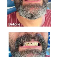 دندان مصنوعی اقساط و بیمه|خدمات آرایشگری و زیبایی|کرمان, |دیوار