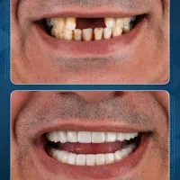 ایمپلنت دندان فقط با 4.980|خدمات آرایشگری و زیبایی|تهران, توحید|دیوار