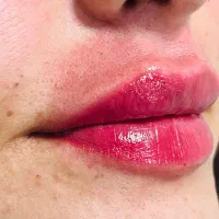 آف ویژه خدمات ژل لب/ بوتاکس/فیلر(دکترسعیدی سوق)