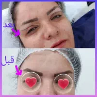 تخلیه وتزریق چربی لابیا جراحی پلک دایرکت اتوپلاستی|خدمات آرایشگری و زیبایی|دورود, |دیوار