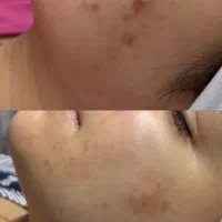 مدل فیشال پوست