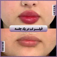 تخفیفات ۵۵٪ دکتر ملائی ،مزو بوتاکس فیلر ژل لب روسی|خدمات آرایشگری و زیبایی|مشهد, کوثر|دیوار