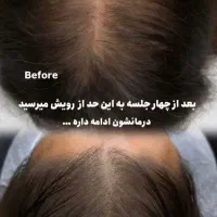 پی آر پی مو و صورت با کیت مخصوص آمریکایی فقط ۱۹۰۰