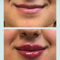 ژل فیلر بوتاکس جوانسازتوسط پزشک زیبایی در کلینیک|خدمات آرایشگری و زیبایی|مشهد, کوثر|دیوار