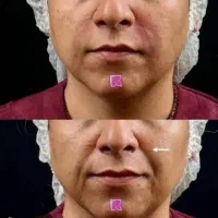 فیلر بوتاکس طب سوزنی