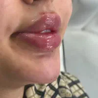 ژل،فیلربادی،بیکینی،بوتاکسprp لیفت صورت|خدمات زیبایی و سلامت|تبریز, |دیوار