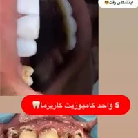 آموزش زیبایی دندانپزشکی .کامپوزیت وبلیچینگ .اقساطی