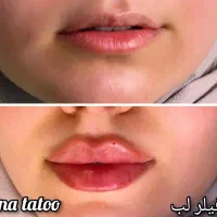 بوتاکس/تزریق ژل/ جوانسازی /پلکسر