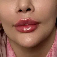 در افسریه ژل و فیلر مزوتراپی چربی سوز غبغب جوانساز