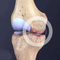 بهبود دیسک کمر