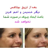 لیزر موهای زائد با الکس کندلای اصل آمریکایی|خدمات آرایشگری و زیبایی|تهران, شاهین|دیوار
