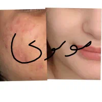 روشن کننده وضدلک درمانی بدون بازگشت تضمینی|آرایشی، بهداشتی، درمانی|یاسوج, |دیوار