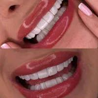 کامپوزیت،لمینت، زیبایی