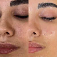 فیشیال تخصصی ویژه آقایان درکلینیک زیرنظرپزشک|خدمات آرایشگری و زیبایی|مشهد, صیاد شیرازی|دیوار