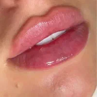 مدل جهت تزریقات فیلر