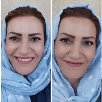 ۲۵ میلیون تخفیف ساخت دندان مصنوعی ژاپنی