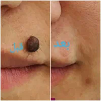 پاک کردن تاتوهای قدیمی وجدید مثل حیوانات ونوشتاری|خدمات آرایشگری و زیبایی|قم, بلوار امین و ساحلی|دیوار