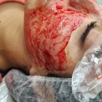 تخفیف مزوتراپی صورت|خدمات آرایشگری و زیبایی|قائم‌شهر, |دیوار