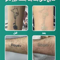 پاک کردن تتو مجموعه پزشکان اولند