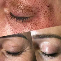 پلاسما جت. لیفت ولمینت ابرو و مژه