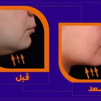 لاغری موضعی بدون جراحی و رژیم سخت