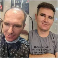 کلینیک تخصصی کاشت مو در تبریز|خدمات آرایشگری و زیبایی|اردبیل, |دیوار