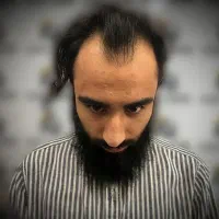 کاشت مو تنها با ۱۵ میلیون تومان|خدمات آرایشگری و زیبایی|بومهن, |دیوار