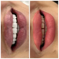 دندانپزشکی اقساطی،جشنواره کامپوزیت و لمینیت