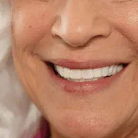 لیمینت دندان معجزه قرن|آرایشی، بهداشتی، درمانی|تهران, آسمان|دیوار