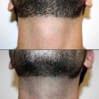 لیزر فول بادی فقط و فقط*۴۵۰ * بدوو که جا نمونی *|خدمات آرایشگری و زیبایی|زنجان, |دیوار