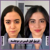 تخفیفات ۵۵٪ دکتر ملائی ،مزو بوتاکس فیلر ژل لب روسی|خدمات آرایشگری و زیبایی|مشهد, کوثر|دیوار