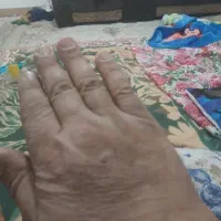 شکسته بند ودرفتگی مچ پاودست وانگشتان