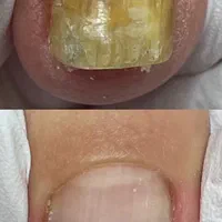 خدمات پودولوژی و پدیکور درمانی ، تخلیه میخچه و ..|خدمات آرایشگری و زیبایی|تهران, فردوس|دیوار