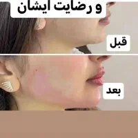 جشنواره تخفیفات یک روزه انجام فیلرزاویه فک وگونه|خدمات آرایشگری و زیبایی|تبریز, |دیوار