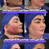 جشنواره سوپرکانتورینگ غبغب