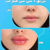 تزریق ژل و بوتاکس