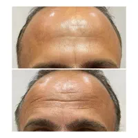 بوتاکس با قیمت باورنکردنی