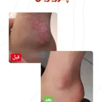 درمان پسوریازیس یا صدفک با گیاهان درمانی|آرایشی، بهداشتی، درمانی|اهواز, دانشگاه چمران|دیوار